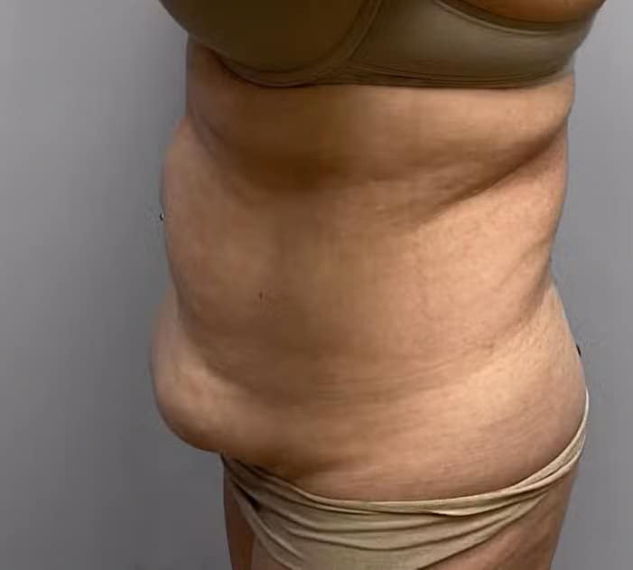 Before Image: Abdominoplasty & Lipo – Dr.Howell - left-side