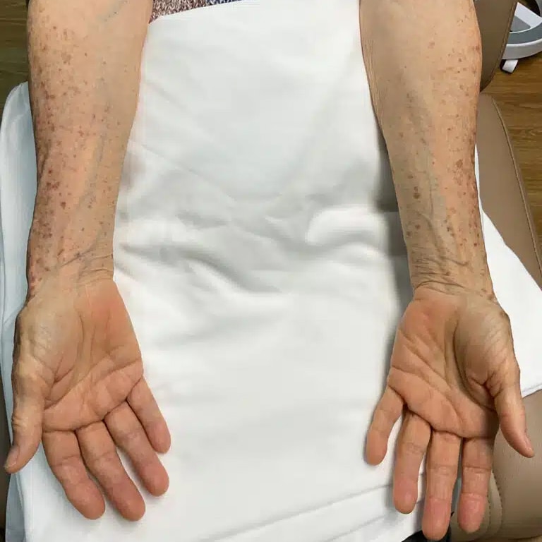 Before Image: Laser Treatment- Jade - back