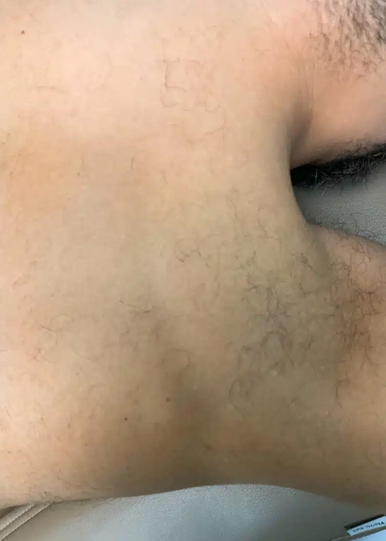 Before Image: Laser Hair Removal- Jade - right-side