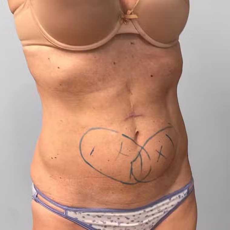 Before Image: Coolsculpting- Jessica - right-front-oblique