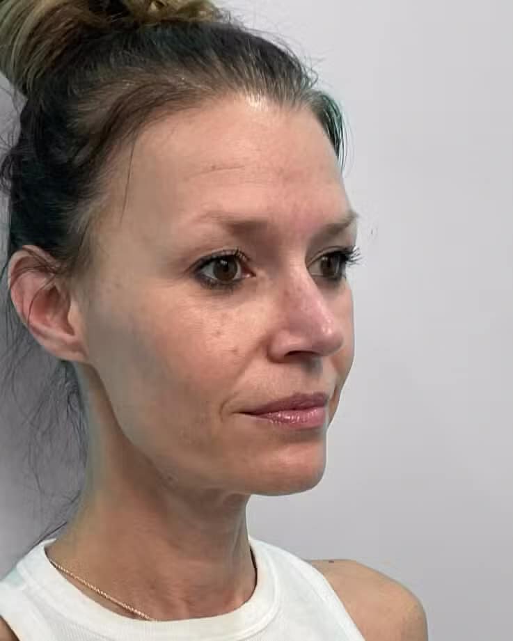 Before Image: Juvéderm Vollure & Botox – Joy - right-front-oblique