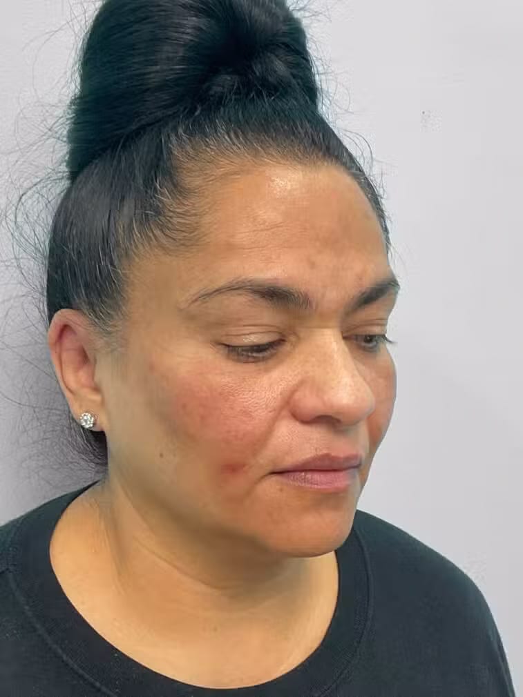 Before Image: Botox & Juvéderm- Joy - right-front-oblique