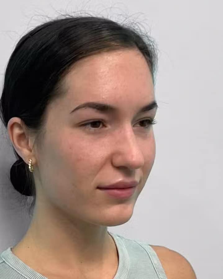 Before Image: Juvéderm Vollure – Joy - right-front-oblique