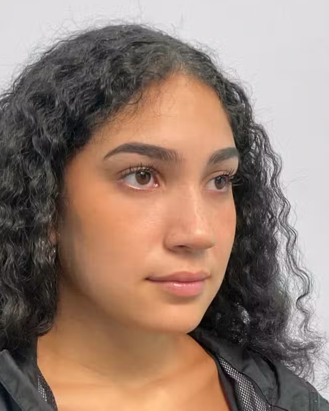 Before Image: Juvéderm Ultra – Joy - right-front-oblique