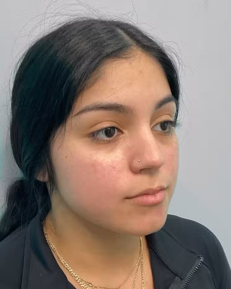 Before Image: Juvéderm Ultra- Joy - right-front-oblique