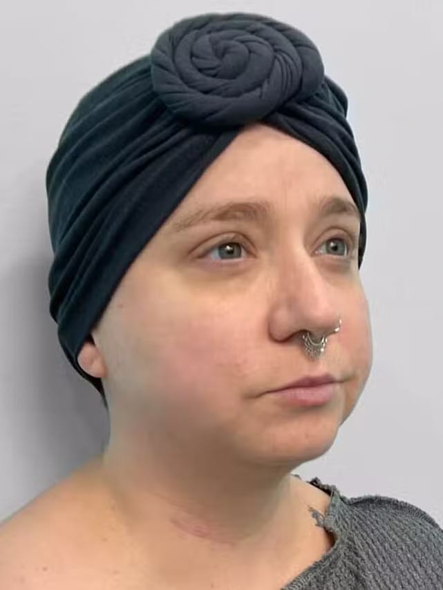 Before Image: Restylane Kysse – Joy - right-front-oblique