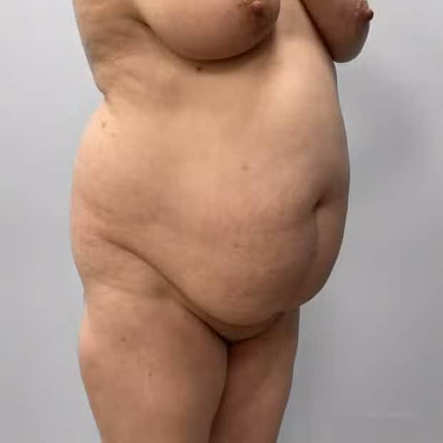 Before Image: Tummy Tuck, Lipo, & BBL – Dr. Tucker - right-front-oblique