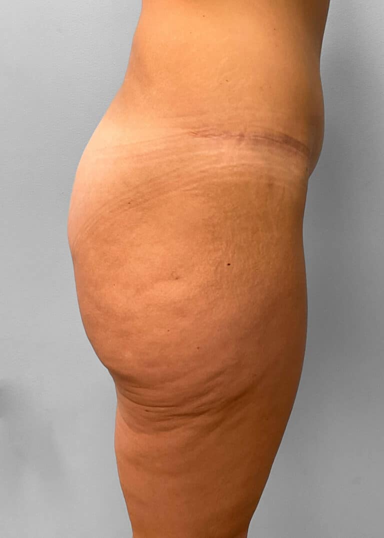 Before Image: Butt Lift- Dr. Howell - right-side