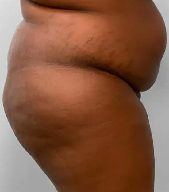Before Image: BBL Fat Transfer- Dr. Tucker - right-side