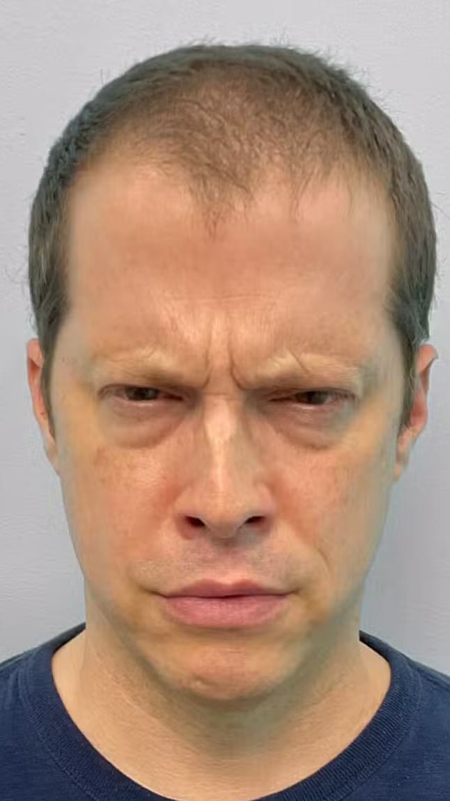 Before Image: Botox- Joy - front