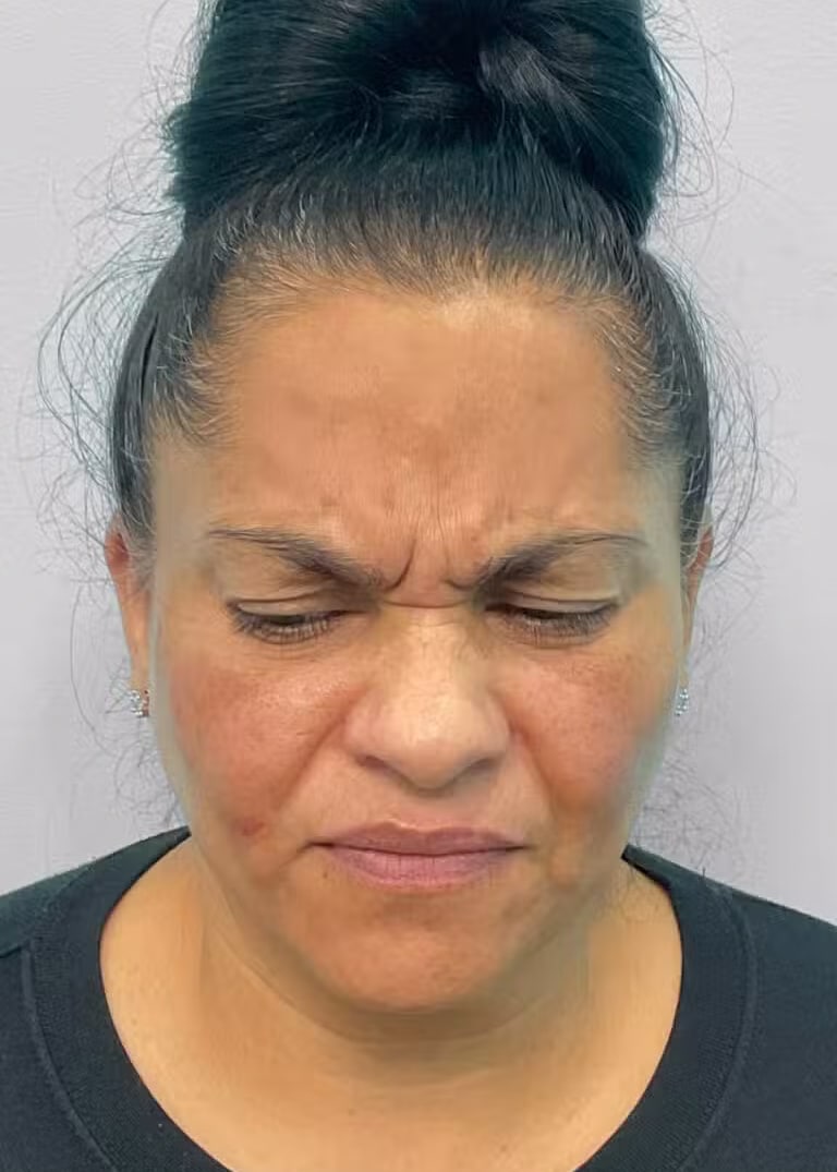 Before Image: Botox & Juvéderm- Joy - front