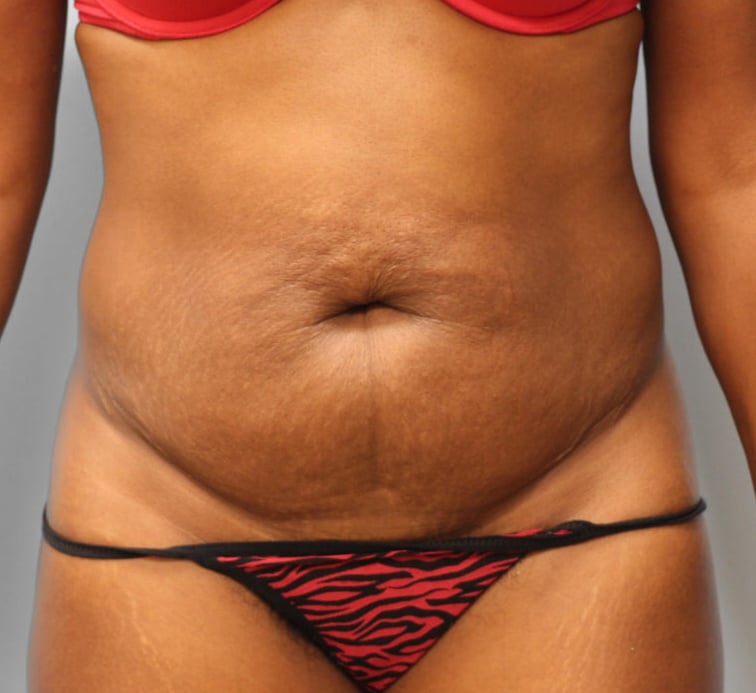 Before Image: Abdominoplasty (Tummy Tuck) – Dr. Howell - front
