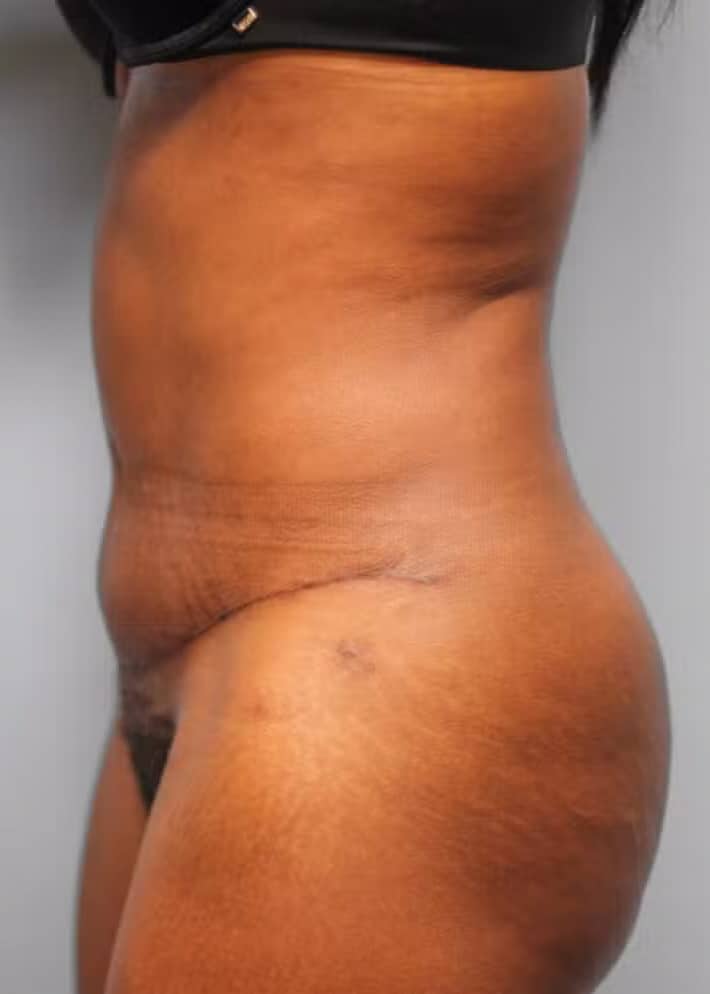 After Image: Abdominoplasty (Tummy Tuck) – Dr. Howell - left-side