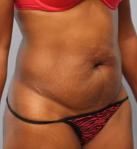 Before Image: Abdominoplasty (Tummy Tuck) – Dr. Howell - right-front-oblique