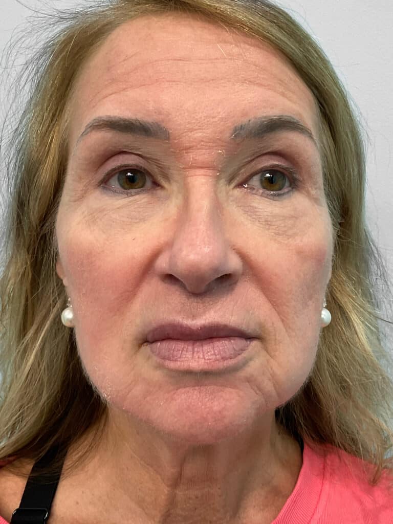 Before Image: Lip Flip – Heather - front