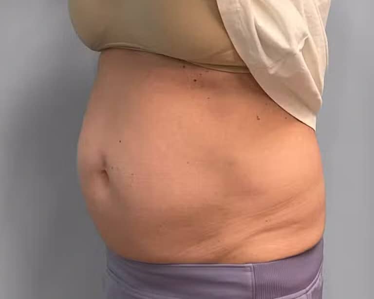 Before Image: Emsculpt Neo- Jessica - left-front-oblique