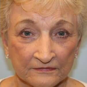 After Image: Facelift, Rhinoplasty, & Blepharoplasty – Dr. Tucker - front