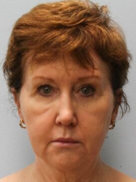 Before Image: Facelift – Dr. Howell - front