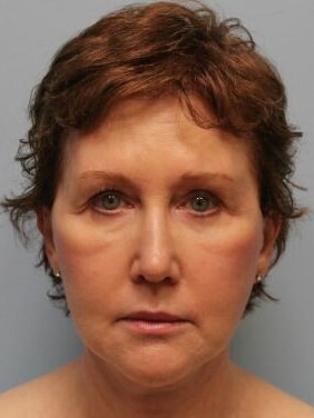 After Image: Facelift – Dr. Howell - front