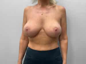 After Image: Breast Augmentation – Dr. Tucker