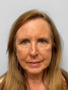 After Image: Blepharoplasty – Dr. Tucker
