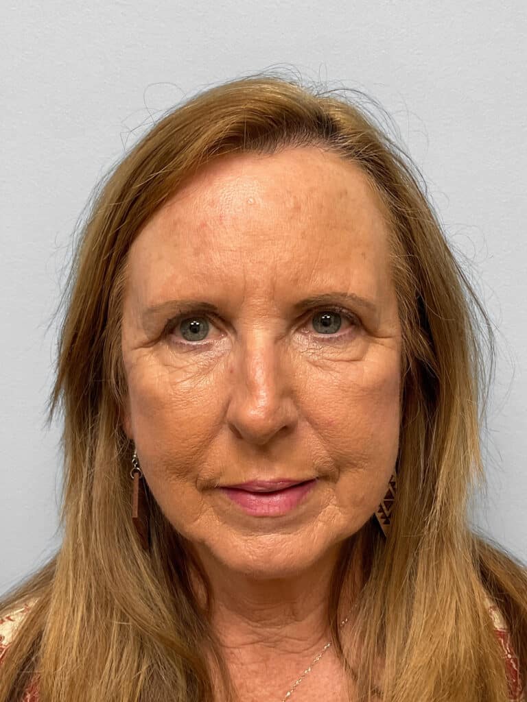 After Image: Blepharoplasty – Dr. Tucker - front