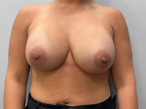 After Image: Breast Augmentation – Dr. Tucker