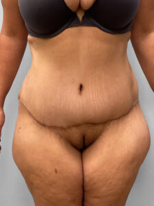 After Image: Tummy Tuck – Dr. Tucker