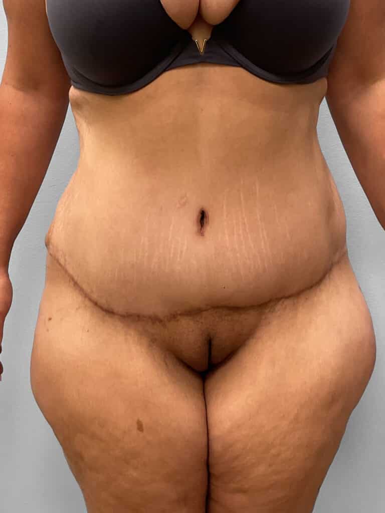 After Image: Tummy Tuck – Dr. Tucker - front