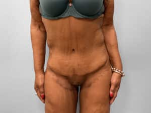 After Image: Tummy Tuck & Thigh Lift – Dr. Tucker