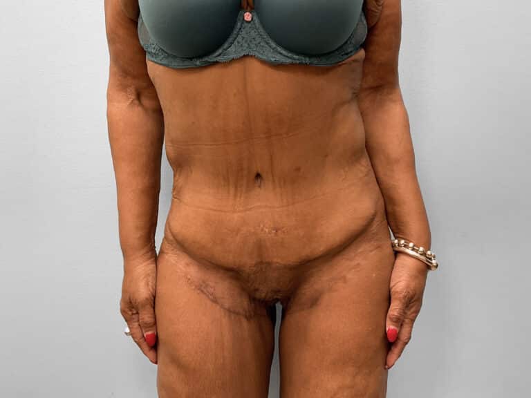 After Image: Tummy Tuck & Thigh Lift – Dr. Tucker - front