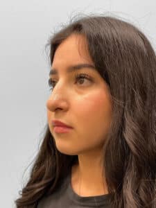 After Image: Rhinoplasty – Dr. Tucker