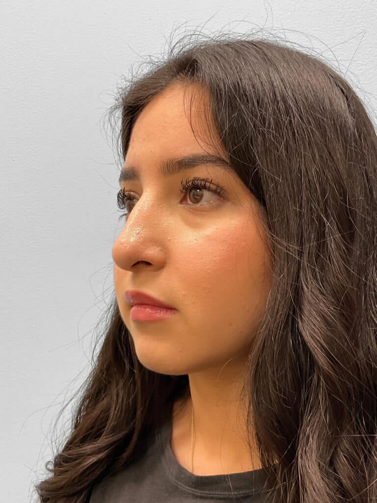After Image: Rhinoplasty – Dr. Tucker - left-front-oblique