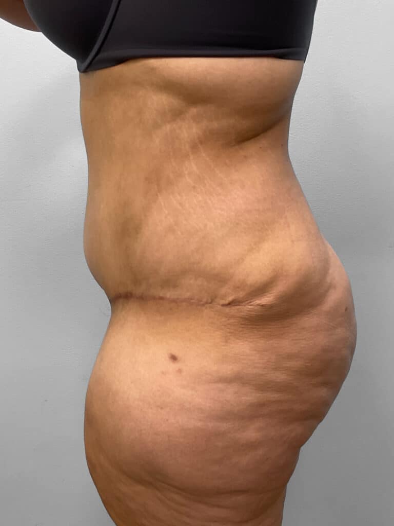 After Image: Tummy Tuck – Dr. Tucker - left-side