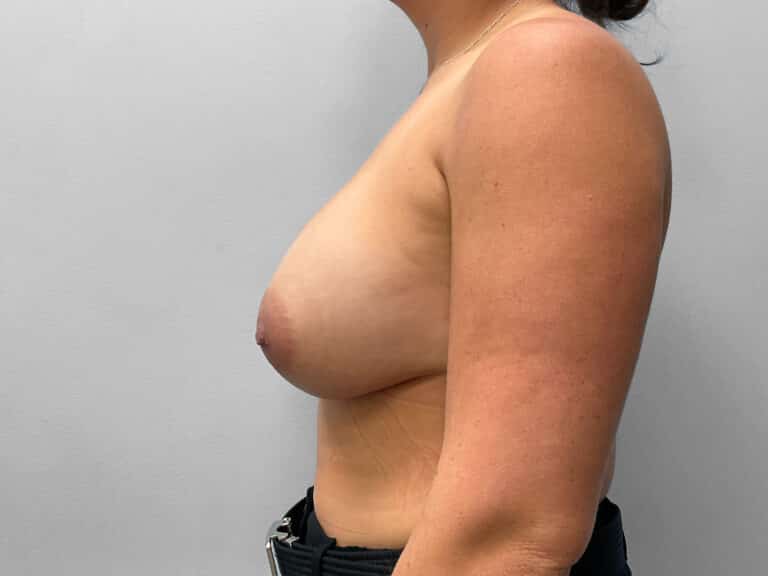 After Image: Breast Augmentation – Dr. Tucker - left-side