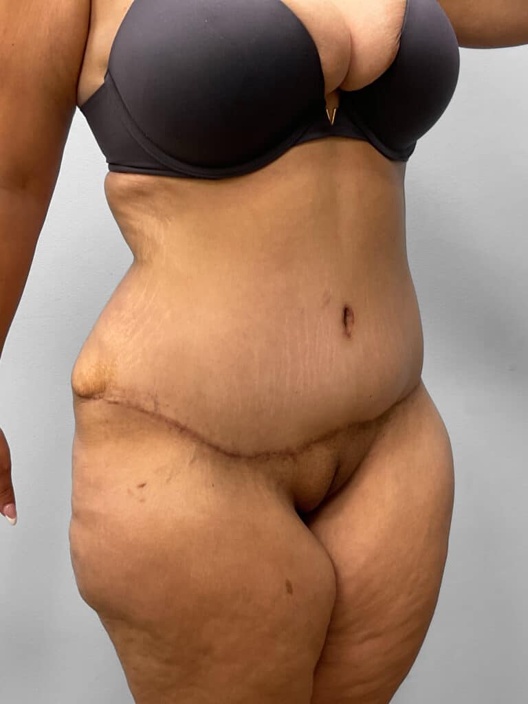 After Image: Tummy Tuck – Dr. Tucker - right-front-oblique