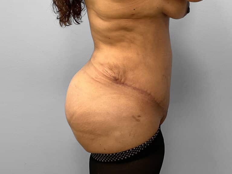 After Image: Mommy Makeover – Dr. Tucker - right-side