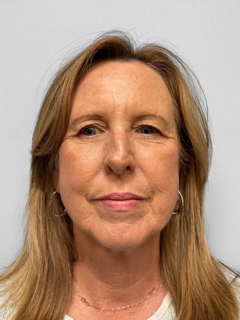 Before Image: Blepharoplasty – Dr. Tucker - front