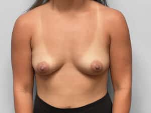 Before Image: Breast Augmentation – Dr. Tucker