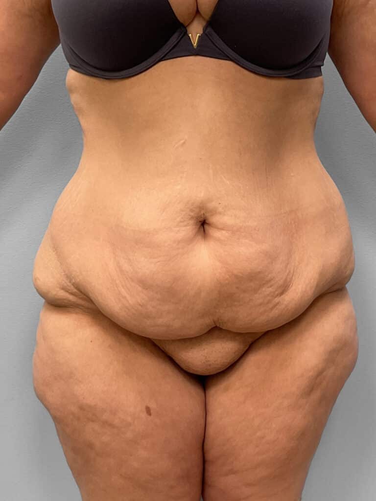 Before Image: Tummy Tuck – Dr. Tucker - front