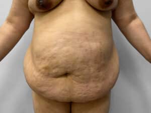 Before Image: Mommy Makeover – Dr. Tucker