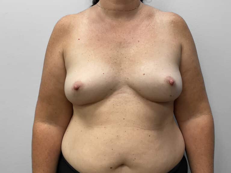 Before Image: Breast Augmentation – Dr. Tucker - front