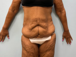 Before Image: Tummy Tuck & Thigh Lift – Dr. Tucker