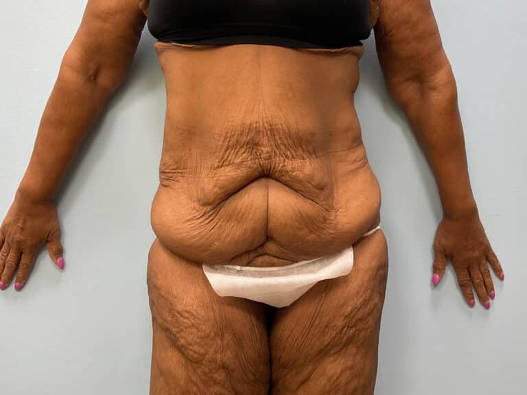 Before Image: Tummy Tuck & Thigh Lift – Dr. Tucker - front