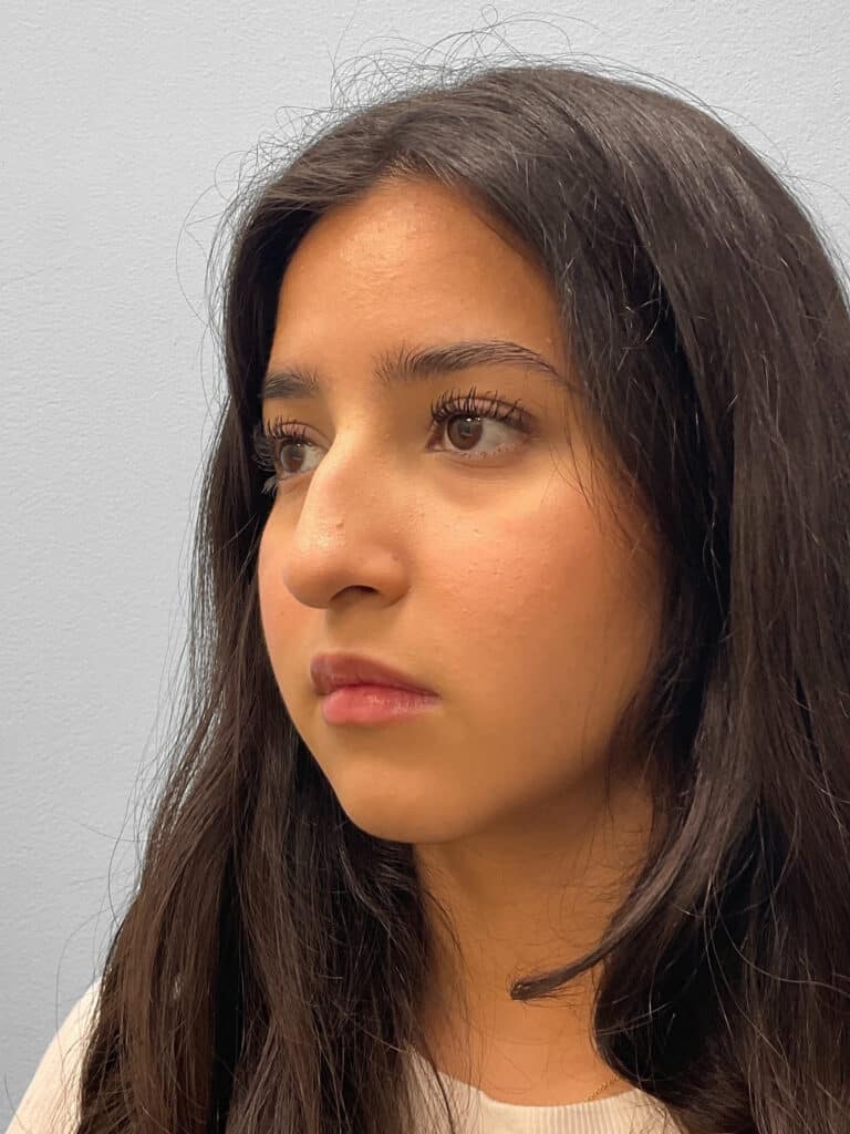 Before Image: Rhinoplasty – Dr. Tucker - left-front-oblique