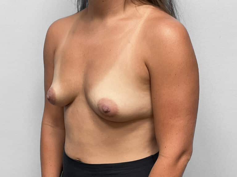 Before Image: Breast Augmentation – Dr. Tucker - left-front-oblique