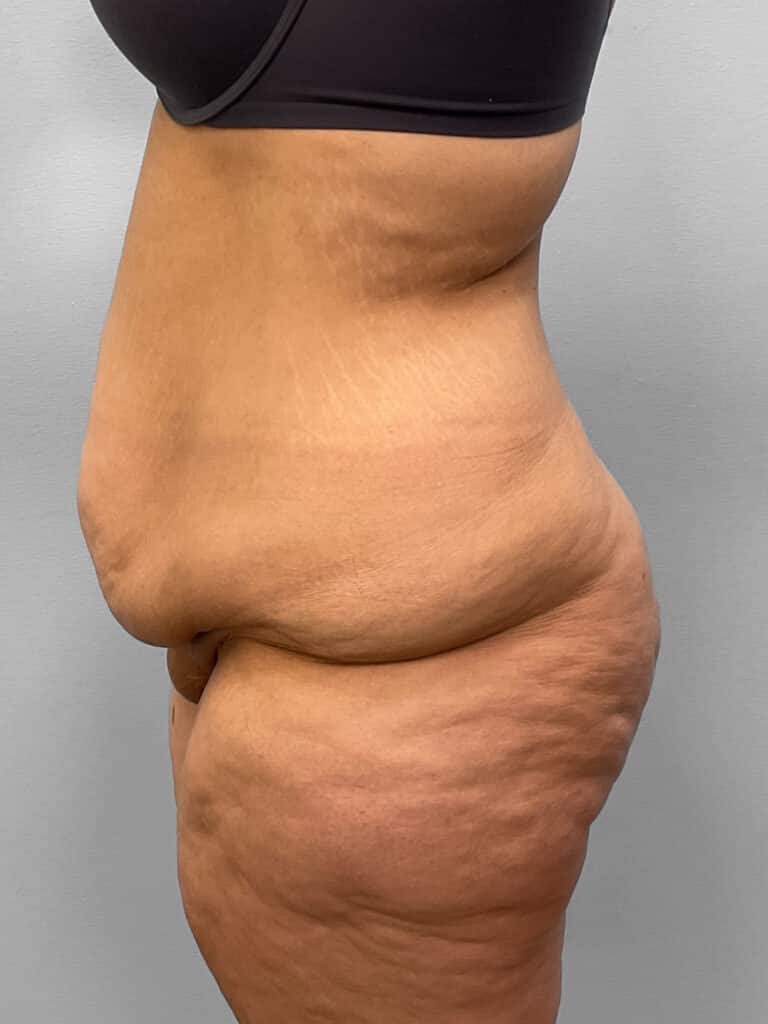 Before Image: Tummy Tuck – Dr. Tucker - left-side