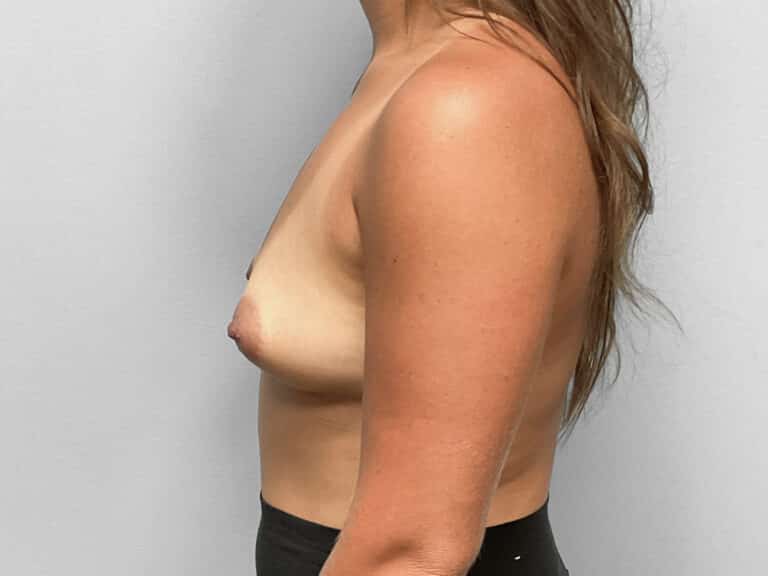 Before Image: Breast Augmentation – Dr. Tucker - left-side
