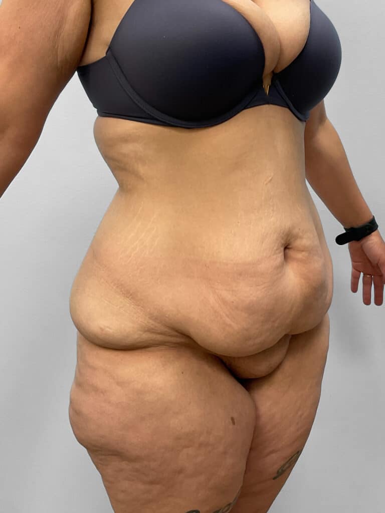 Before Image: Tummy Tuck – Dr. Tucker - right-front-oblique