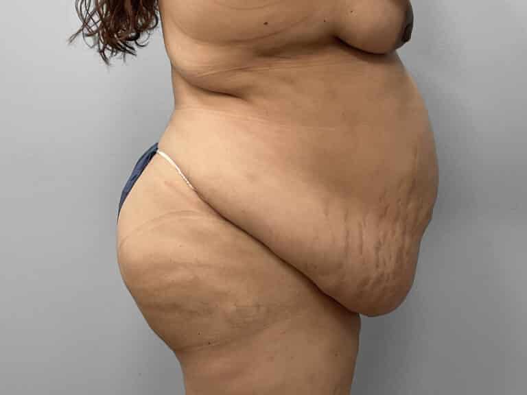 Before Image: Mommy Makeover – Dr. Tucker - right-side